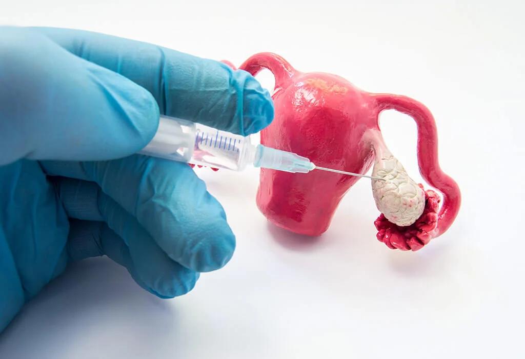 Optimal Use of Ovulation Induction Medications