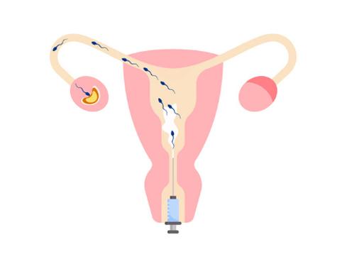 Step-by-Step Stages of the IUI Procedure