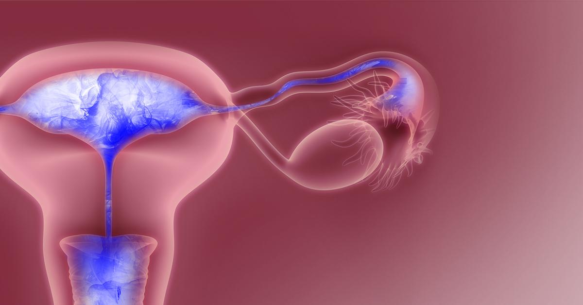 What is a Saline Infusion Sonohysterography (SIS)?