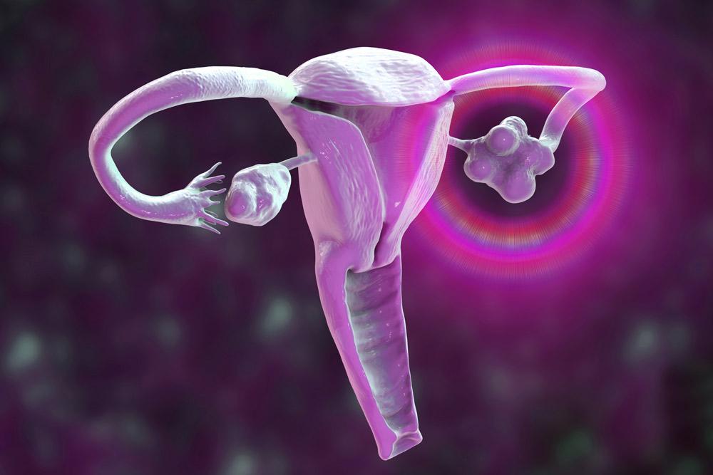 What is the Chronic Uterine Infection Test and Its Impact on Fertility and Pregnancy?