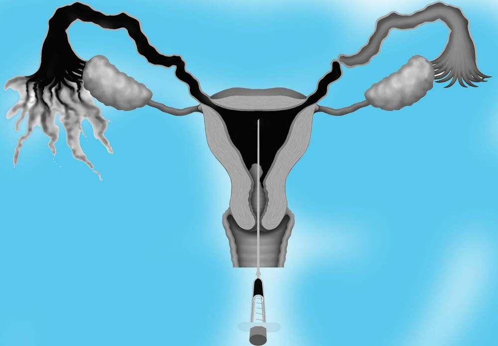 What is a Hysterosalpingography (HSG) Test?