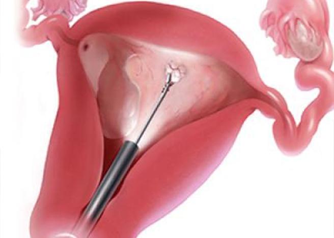 What is Hysteroscopy?